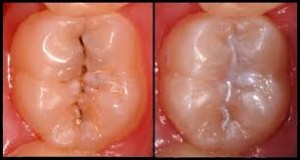 Before and after fissure sealant placement