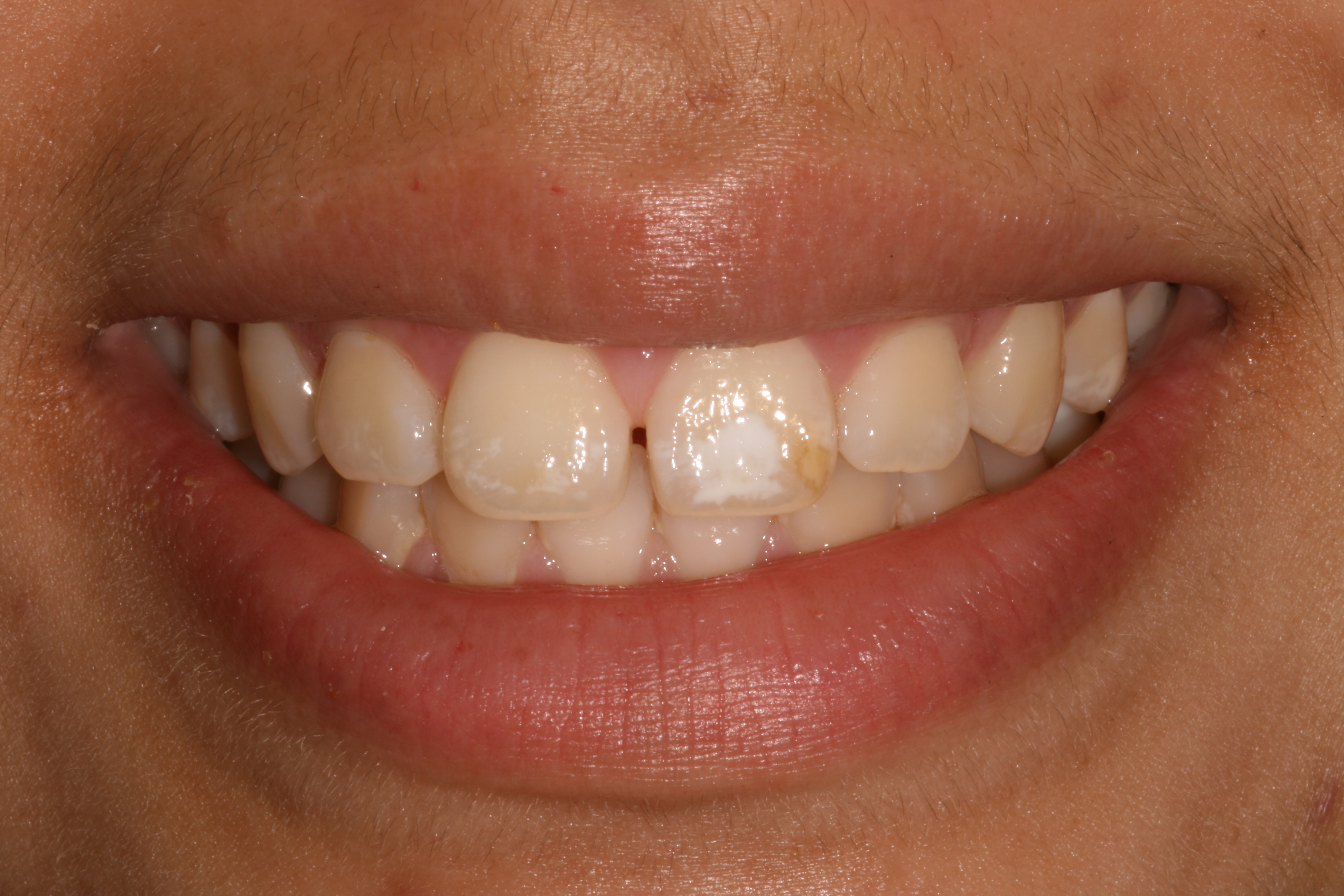 White spots on teeth after whitening