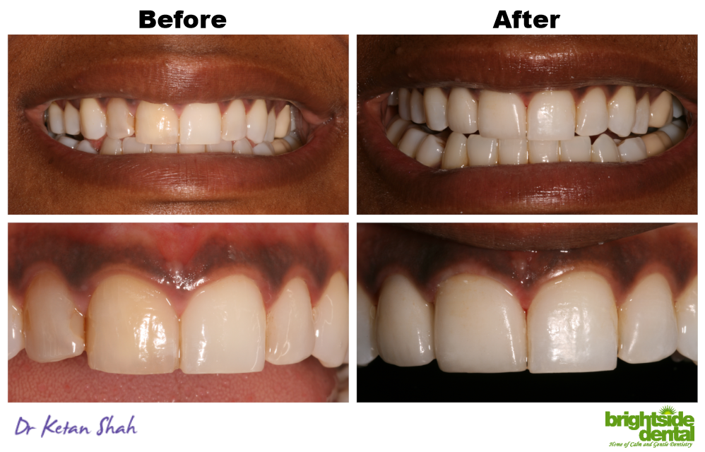 front tooth root canal