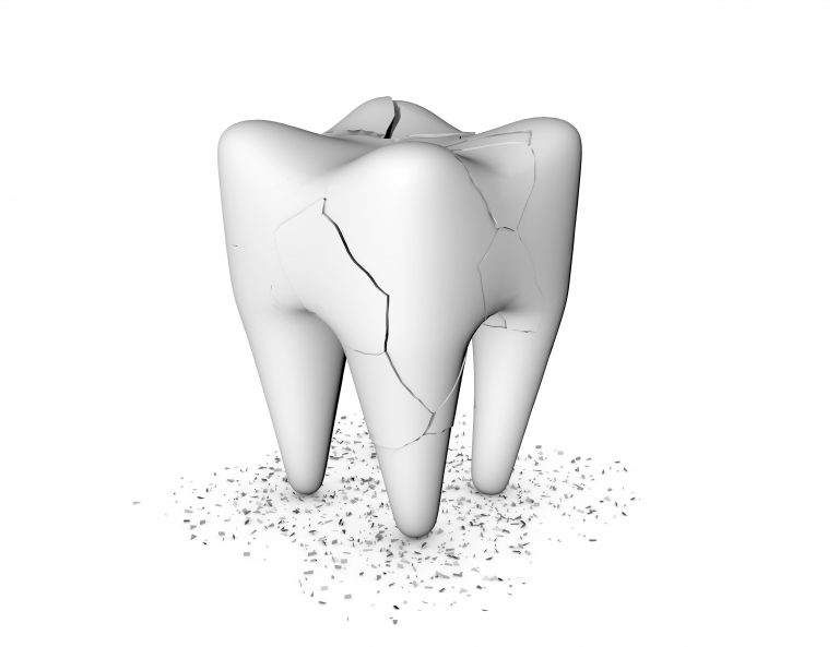 What Are The Signs & Symptoms And Treatments For A Cracked Tooth