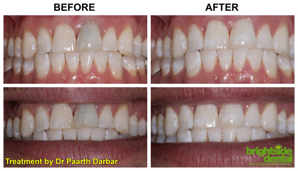 front tooth root canal