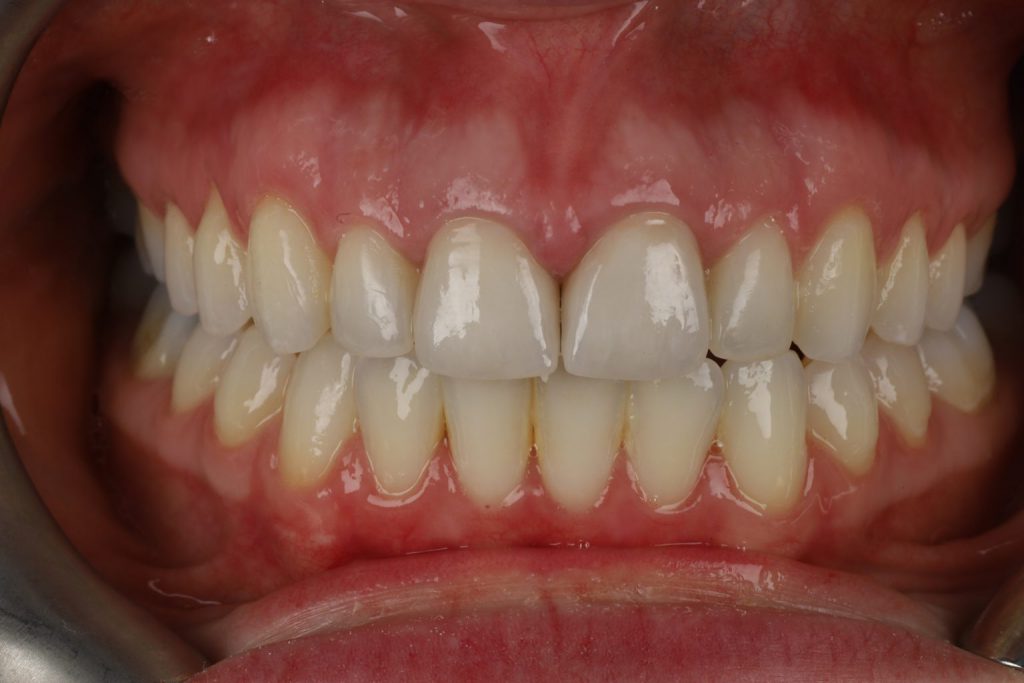 after-crown-treatments