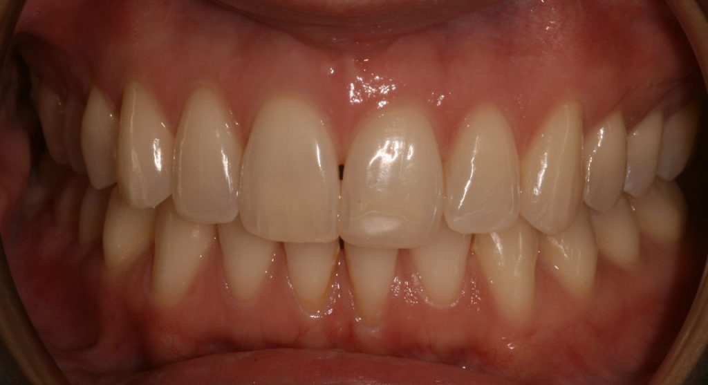 composite bonding