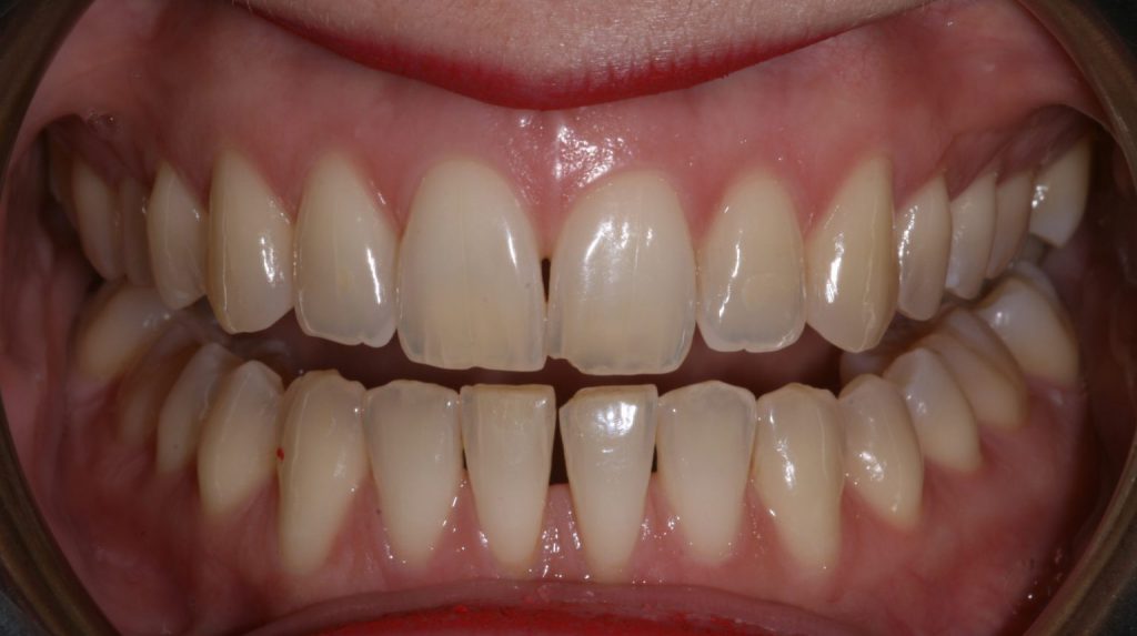 teeth whitening