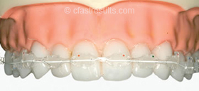 Tooth Alignment Triodent