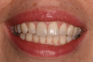 Nesa after smile
