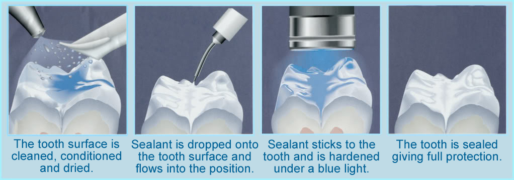Preventive Dentistry for Children and Much More – Fissure Sealants
