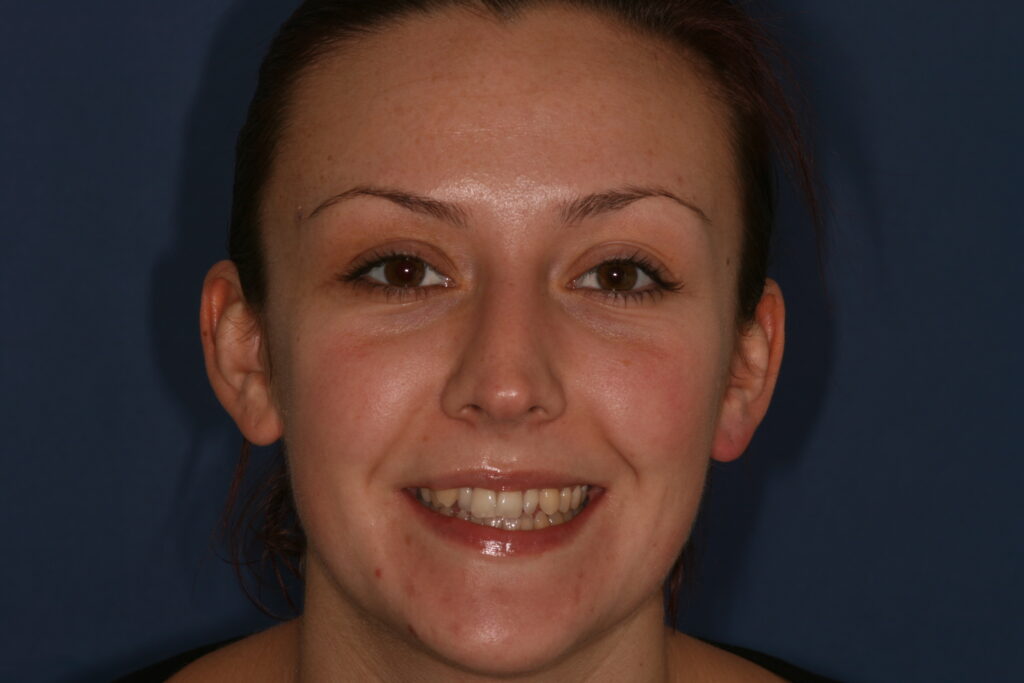 How Would You Like To Have Straighter, Whiter Teeth This Year?