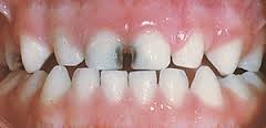 Baby Bottle Tooth Decay