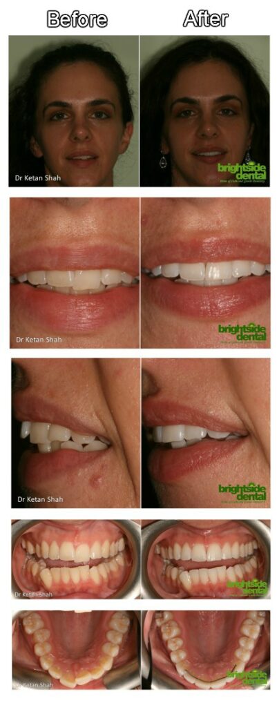 Fast And Easy Teeth Straightening