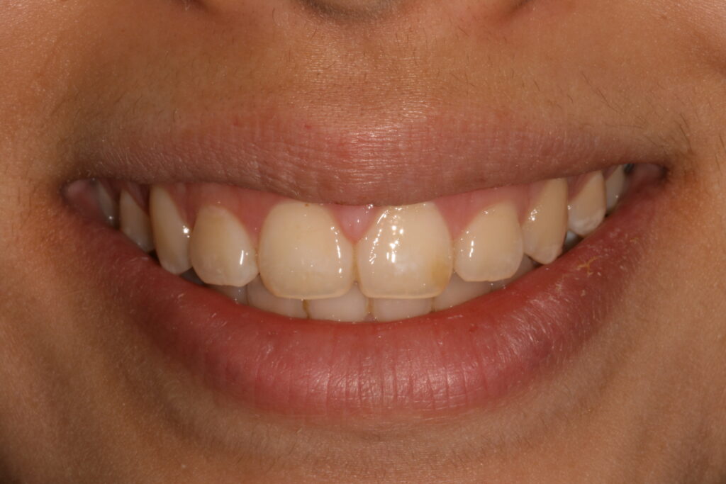 Are White Spots On Your Teeth Affecting Your Smile?