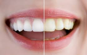 Tips To Combat Stained Teeth