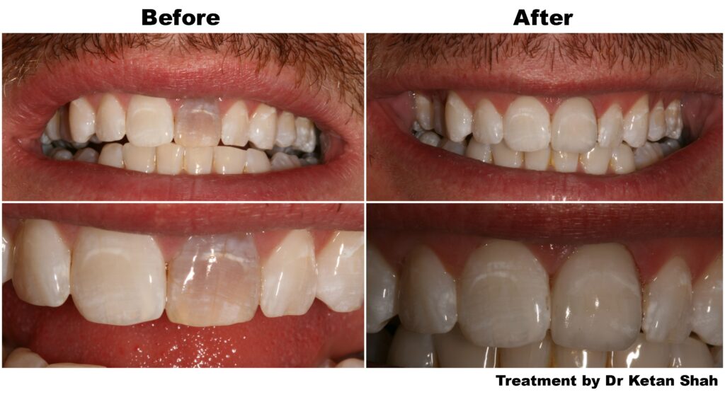 Reducing Fears and Improving Smiles