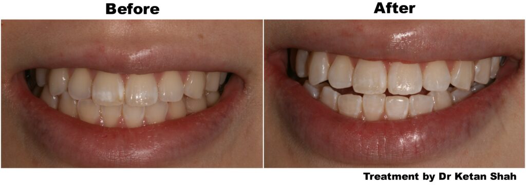 Do Patches On Your Teeth Affect Your Smile?