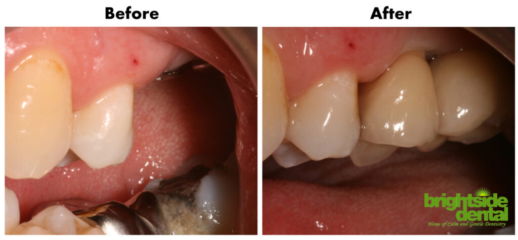 Dental Implants To Replace Missing Teeth
