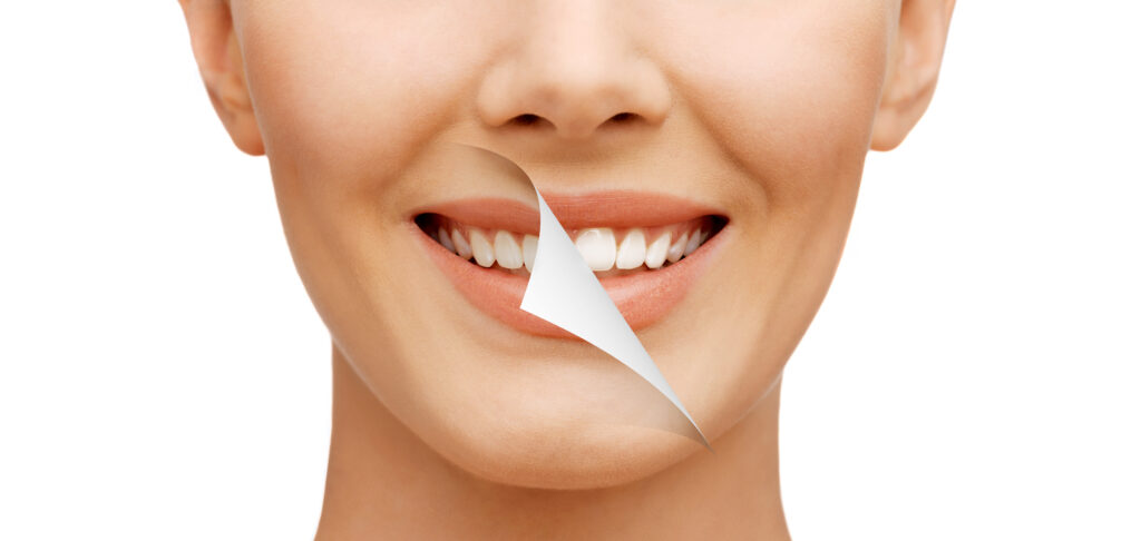 Which Teeth Whitening Option Should You Choose?