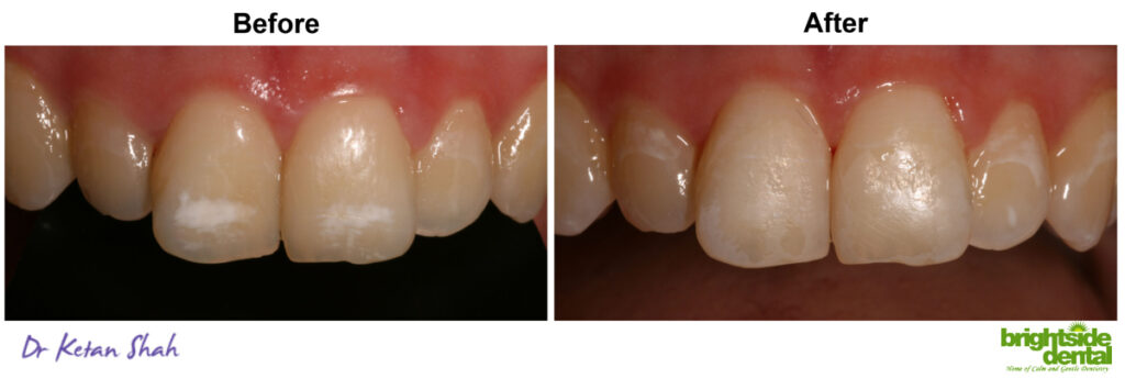 White Patches Affecting Your Smile And Confidence?