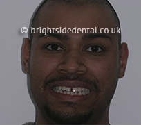 Before Fullface