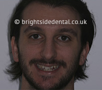 Before Fullface