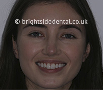 Before Fullface