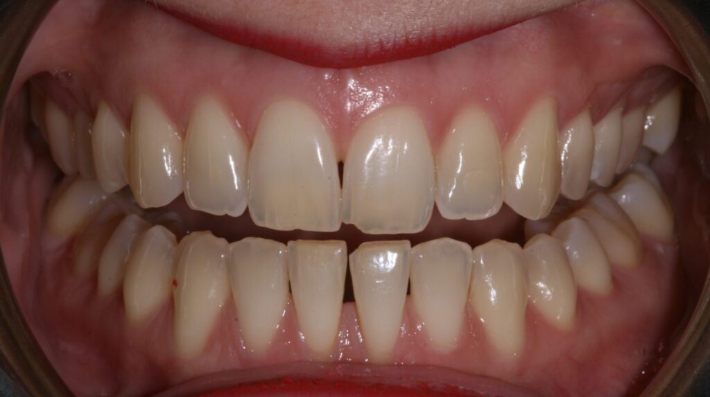 teeth whitening