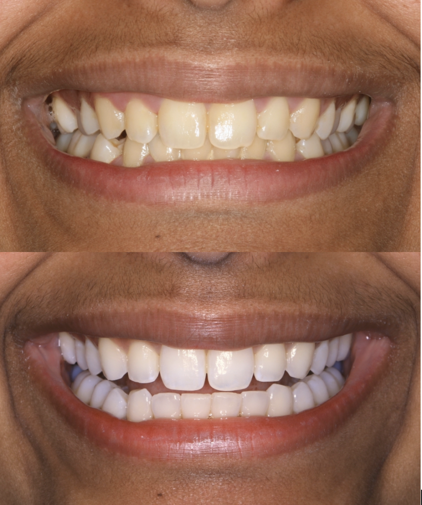 £100 off teeth whitening – book before November 8th