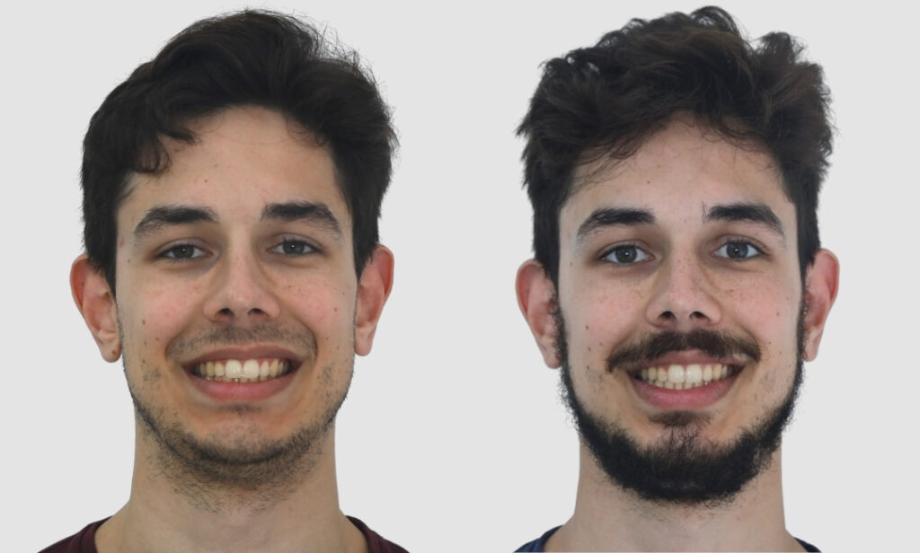 Smile of The Month: From Crowding to Confidence